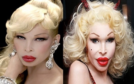 A picture of Amanda Lepore before (left) and after (right) cheekbone augmentation.